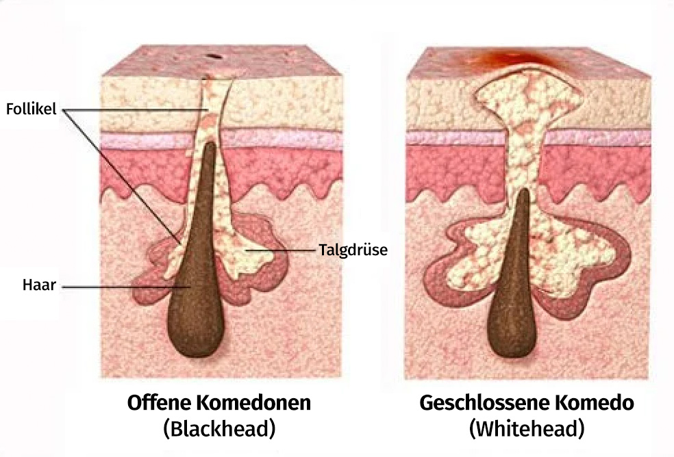 akne-komedonen-offen-geschlossen