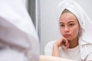 hormonelle veränderungen, die pickel verursachen