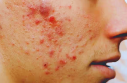 pickel-im-gesicht