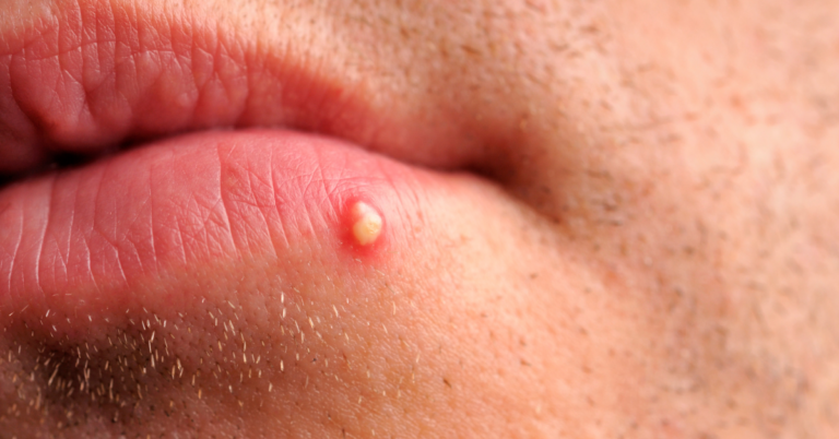 Pickel an der Lippe: Ursachen und Behandlung + Tipps [2025]