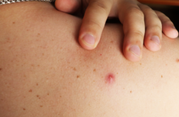 Großer Pickel am Rücken: Ursachen und Behandlung + Tipps