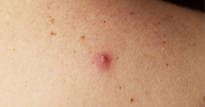 Großer Pickel am Rücken: Ursachen und Behandlung + Tipps [2026]