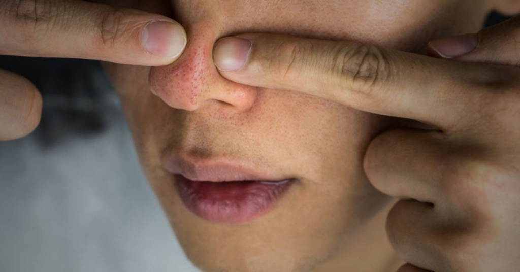 Pickel in der Nase ausdrücken: Richtiger Umgang & Vorbeugungstipps [2025]