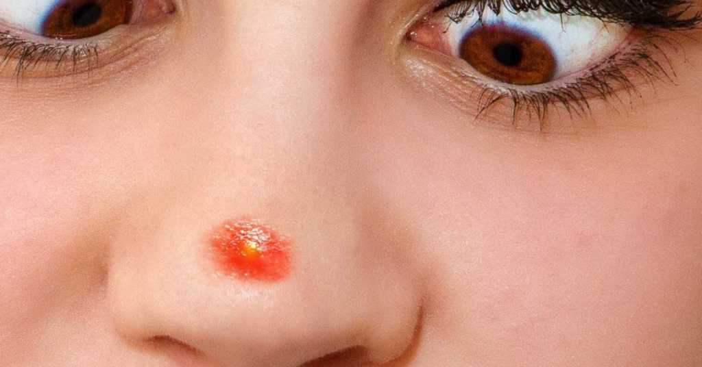 Pickel in der Nase ausdrücken: Richtiger Umgang & Vorbeugungstipps [2025]