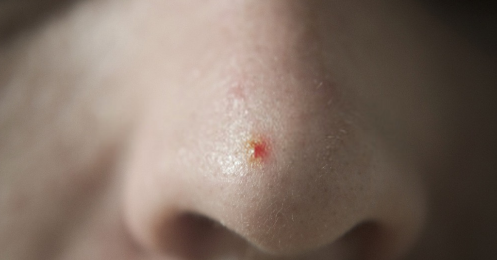 Innen Pickel In Der Nase www.skincure.de