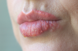 pickel lippe