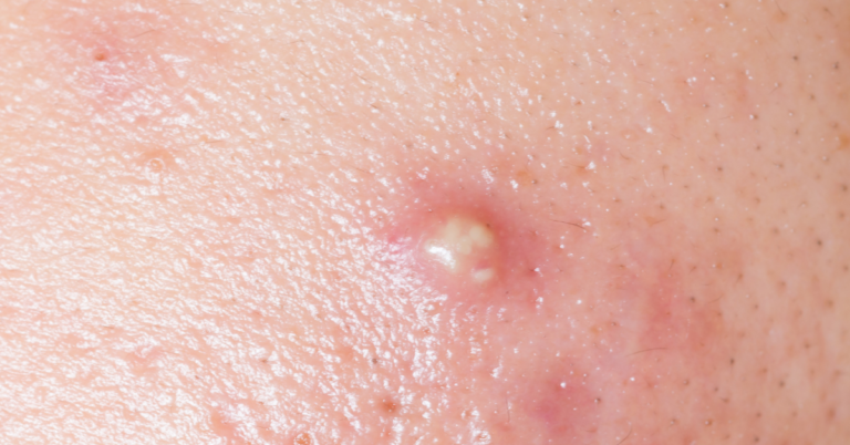 Pickel Mit Blut Und Eiter Gefüllt www.skincure.de