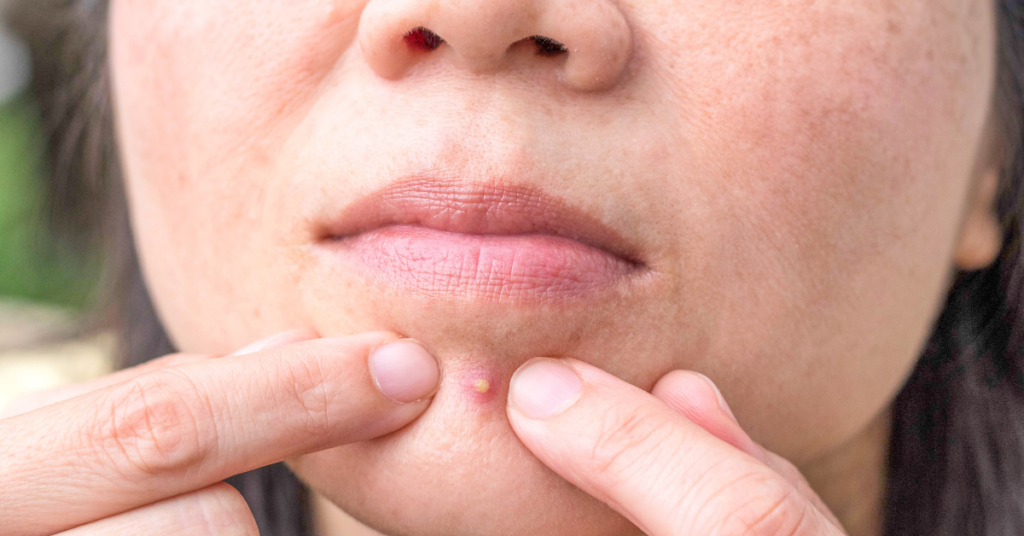 Pickel am Kinn Stoffwechselstörung als Ursache erkennen und behandeln [2025]