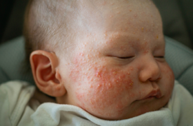 Baby Pickel im Gesicht