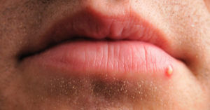 Weiße Pickel auf der Lippe: Ursachen, Behandlung und Prävention für