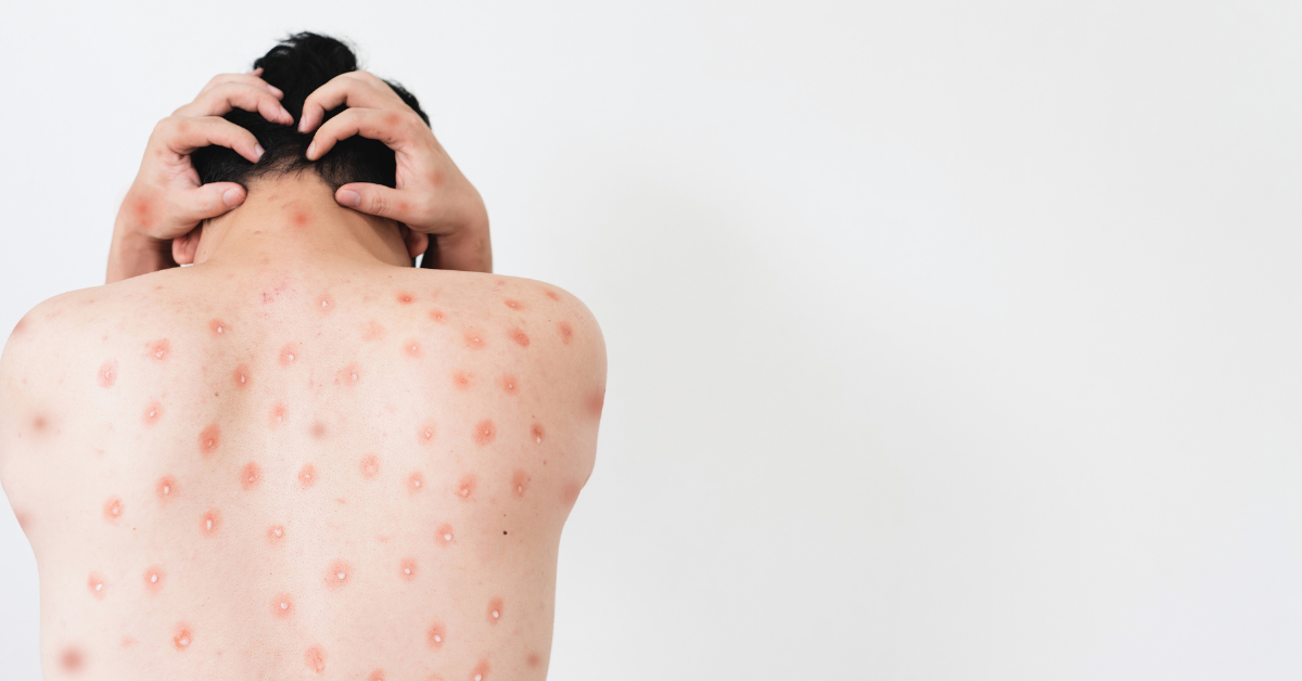 Plötzlich überall Pickel am Körper? Ursachen und wirksame Lösungen entdecken [2025]