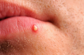 Weiße Pickel auf der Lippe