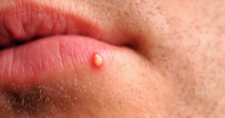 Weiße Pickel auf der Lippe: Ursachen, Behandlung und Prävention für