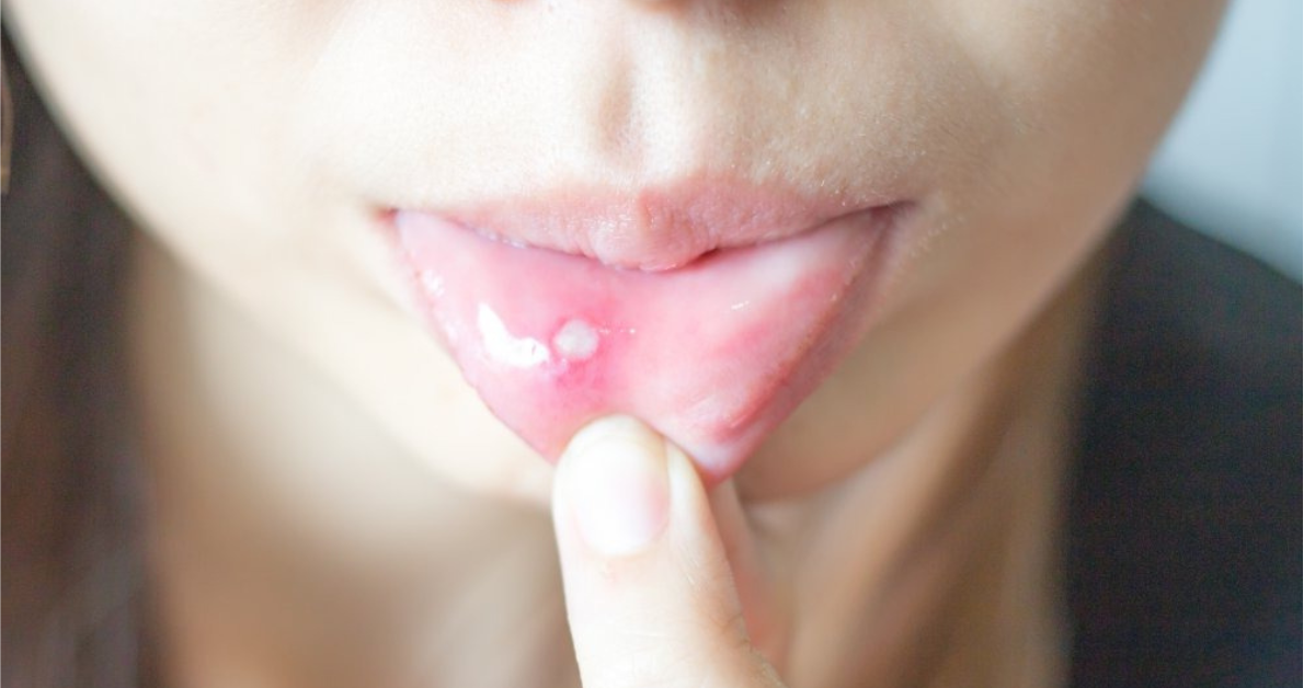 Pickel Lippe Innen Ursachen, Behandlung und Hausmittel gegen schmerzhafte Pickel [2025]